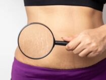 Cellulite et vergetures : comprendre les causes et les solutions efficaces