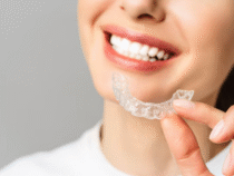 Blanchiment dentaire : retrouvez un sourire éclatant en toute sécurité