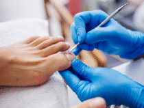 Ongle incarné : les solutions professionnelles pour un traitement efficace et durable