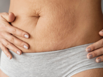 Vergetures rouges vs blanches : traitements dermatologiques